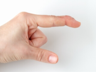 foto van een malletvinger