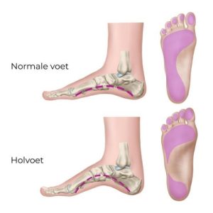 vergelijking-tussen-een-normale-voet-en-een-holvoet